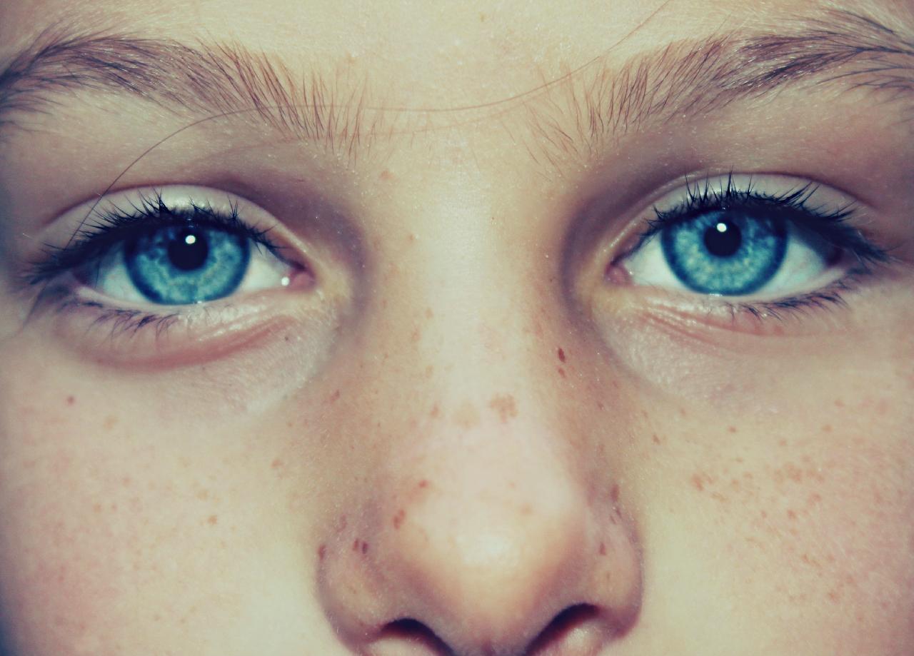 how to remove freckles